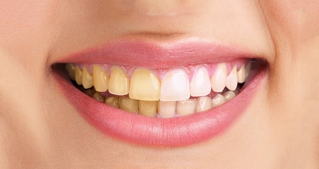 How to Get Rid of Discolored Teeth