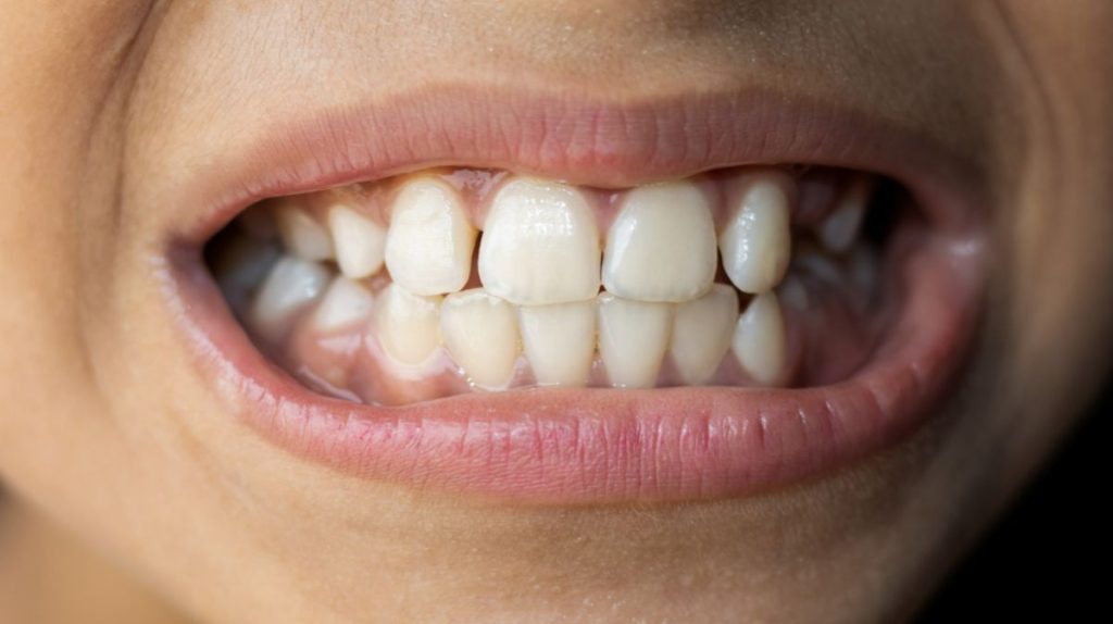 Causes Of Gap Between Teeth And The Best Solution For It