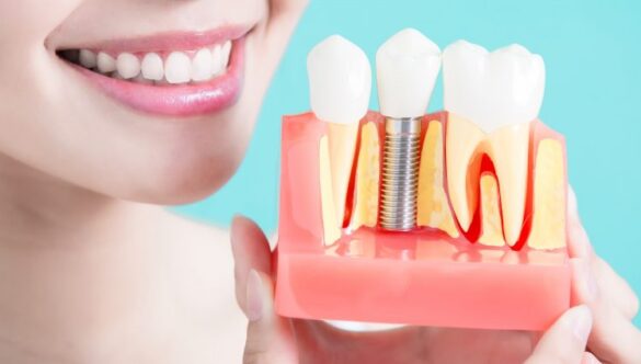 Dental Implants: Are They Worth It?