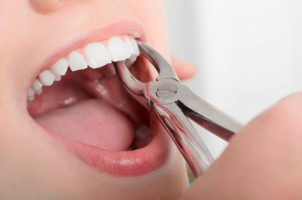 decayed tooth extraction