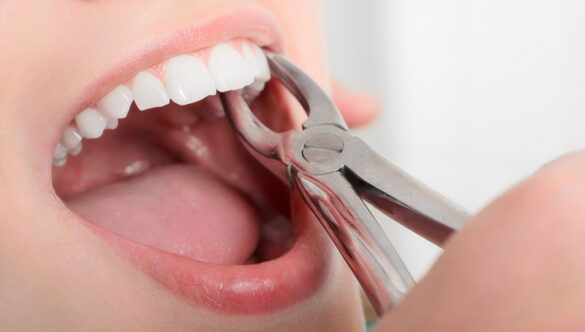 Why is it Important to Get Rid of a Decayed Tooth?