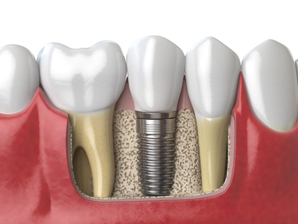 Benefits Of Dental Implants 1024x768
