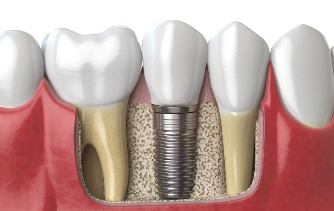 5 Benefits of Dental Implants