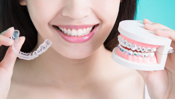 Types of Braces: Which is the Best?
