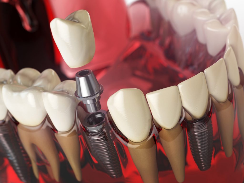 Tooth Implant In The Model Human Teeth Gums And PZHNUNM 1024x768