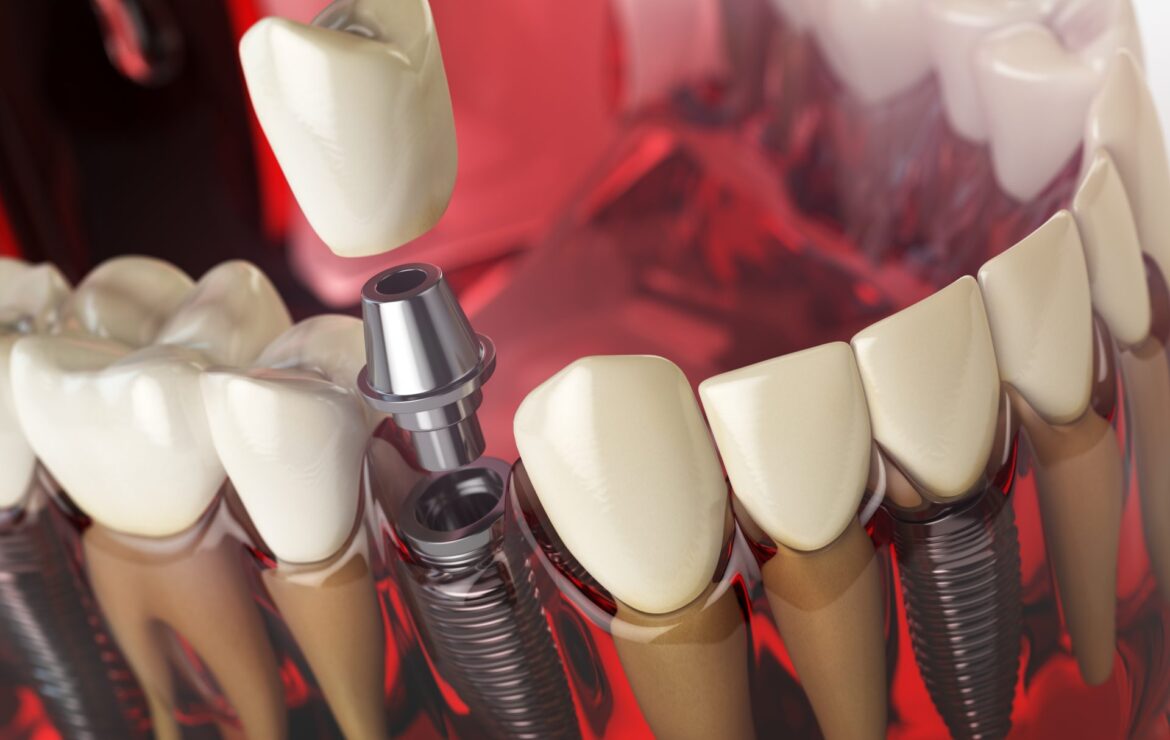 5 Common Questions About Dental Implants in the Philippines