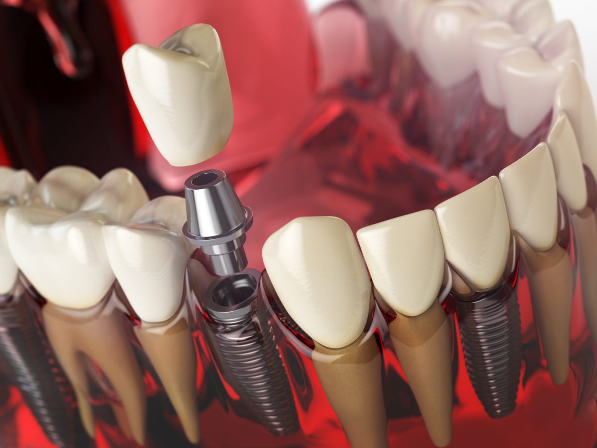 5 Common Questions About Dental Implants in the Philippines - Elevate Dental