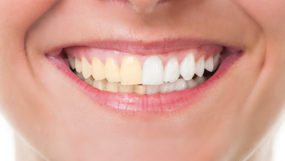 Teeth Stains: Everything You Need to Know