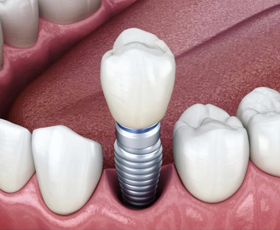 Dental Implant 900x740
