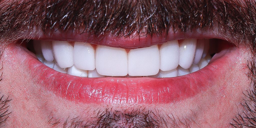 02 Porcelain Veneers Christopher After