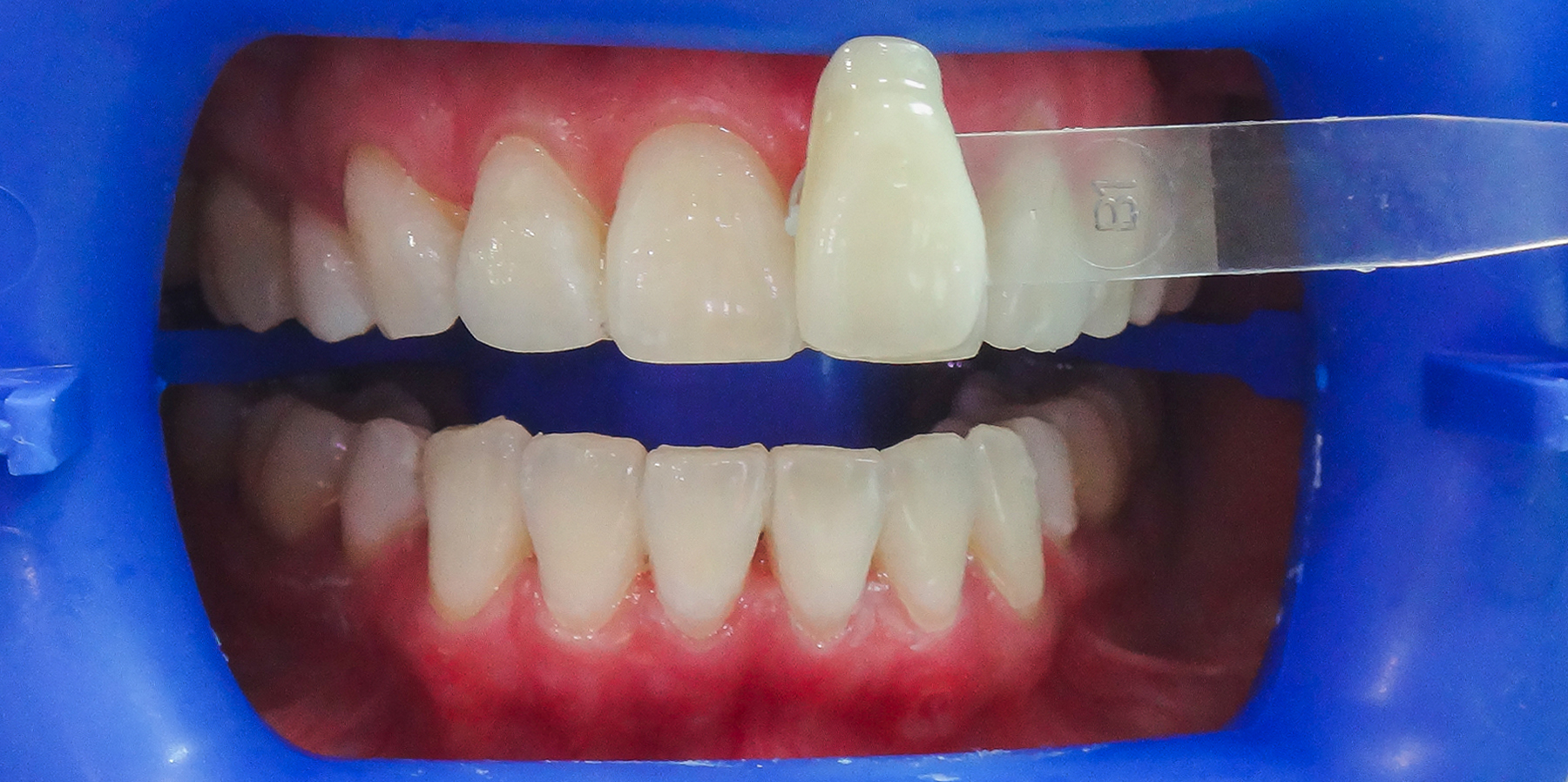 12 Laser Teeth Whitening After