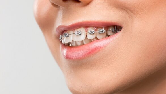 7 Reasons Why You Need Dental Braces
