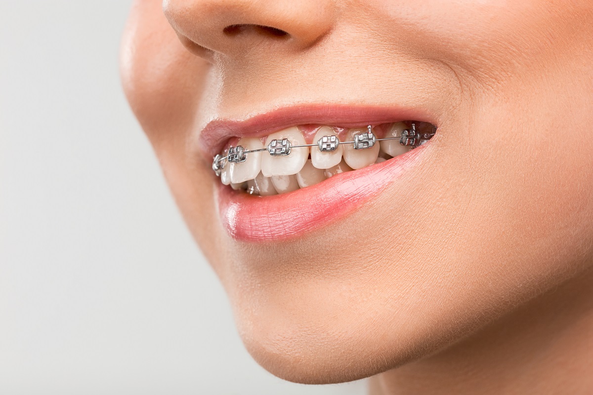 What Happens When You Wear Braces for Too Long - Sunset Plaza Dental