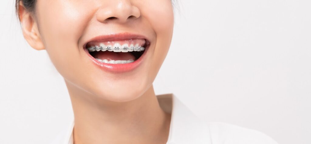 Veneer Vs Braces What Is the Right One for You
