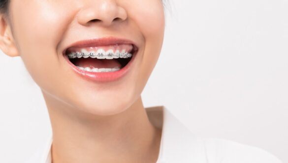 Veneer Vs Braces: What Is the Right One for You?