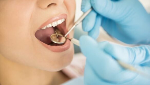 Top 4 Reasons You Need a Dental Bridge