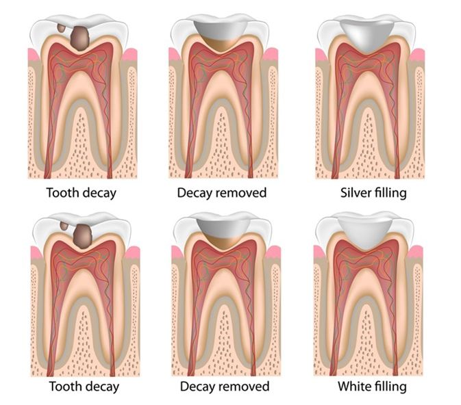 dental filling step x step 02