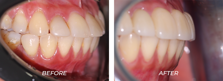 Protruded Teeth 002