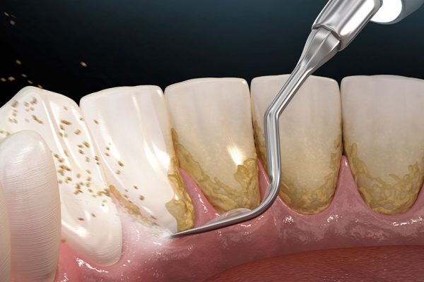 Scaling teeth