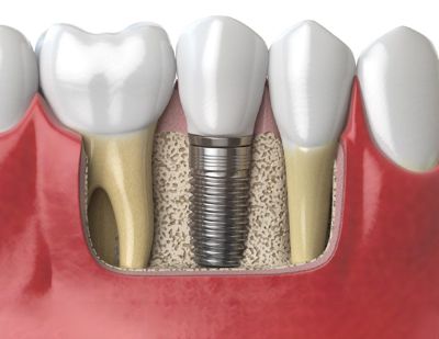 Service Thumb Dental Implant