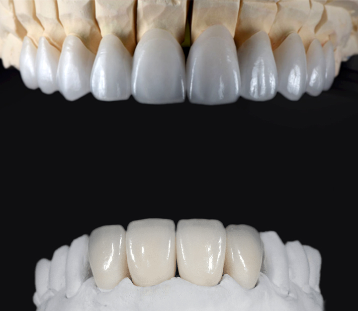 Veneers Zirconia at Suzie Brown blog