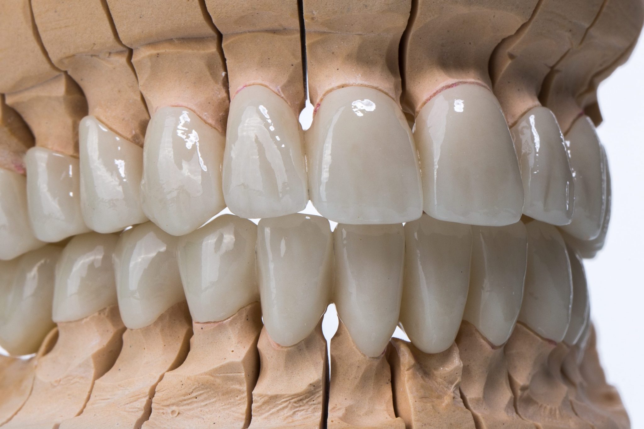 zirconia-veneers-philippines