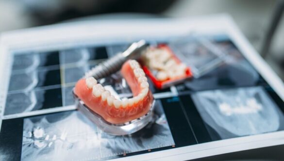 5 Common Questions People Ask Before Getting Dentures