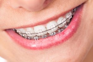 Ceramic Braces