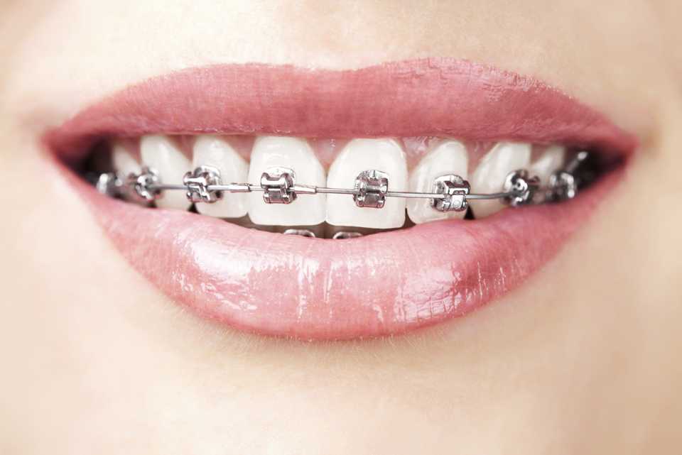 Best Custom Dental Braces & Aligners  Affordable Teeth Braces at Clove  Dental