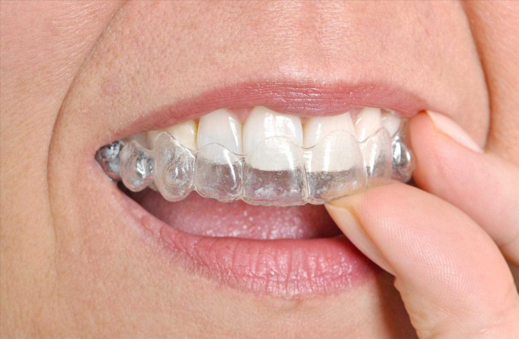 Invisalign Treatment In The Philippines 1024x669
