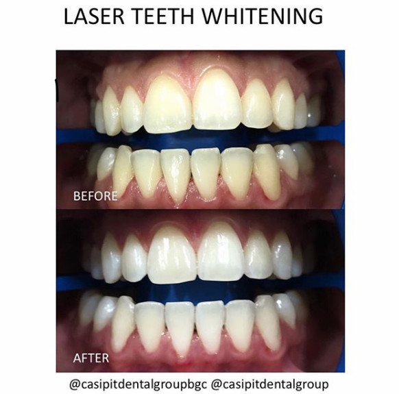 Laser Teeth Whitening Manila Bgc