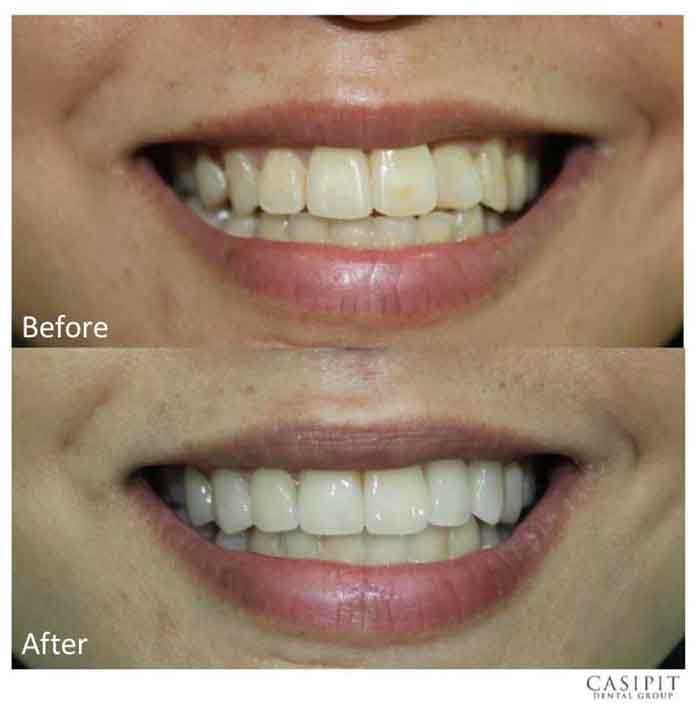 Porcelain Veneers