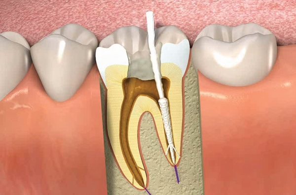 Root Canal Philippines