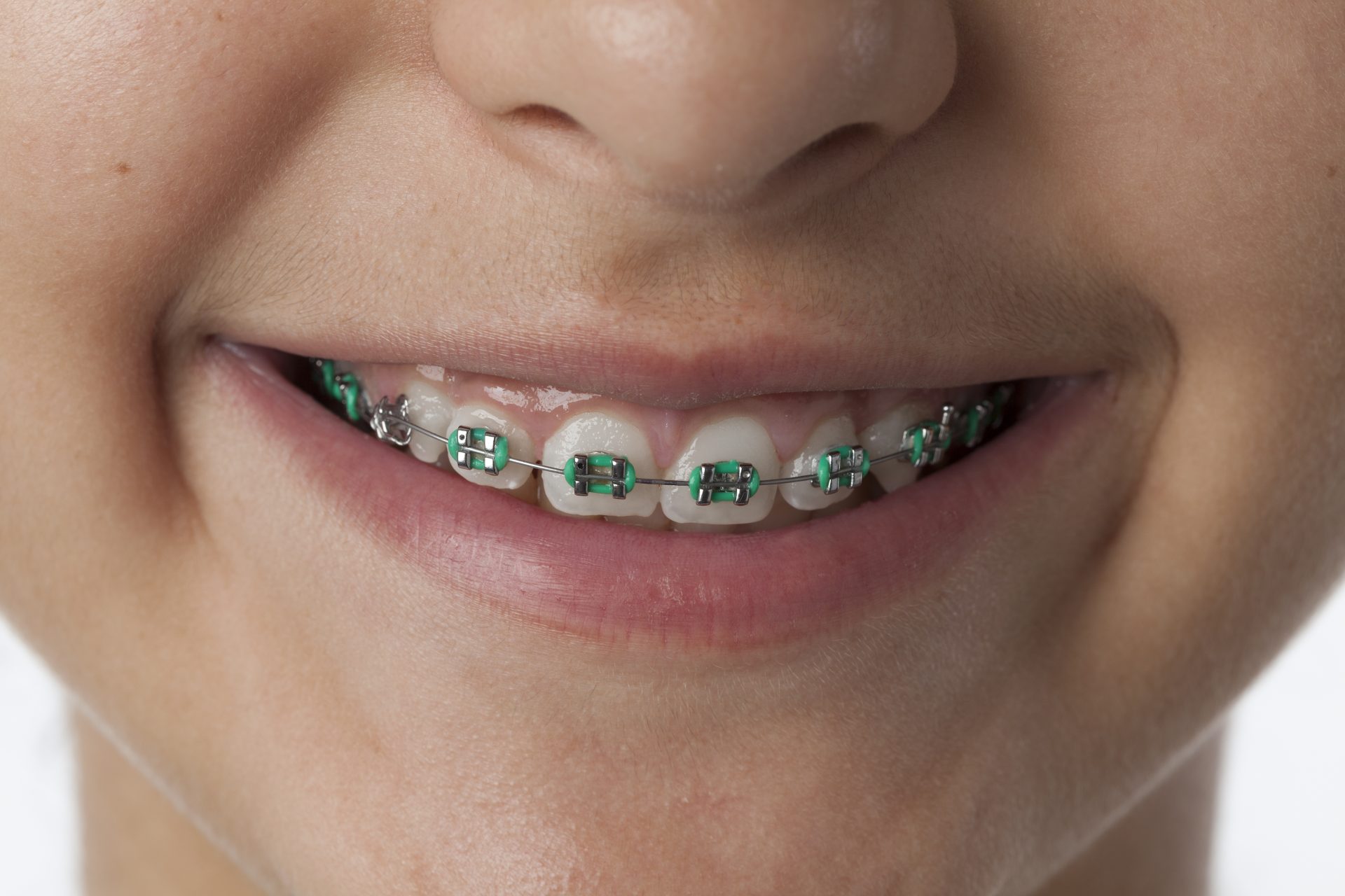 Traditional Braces