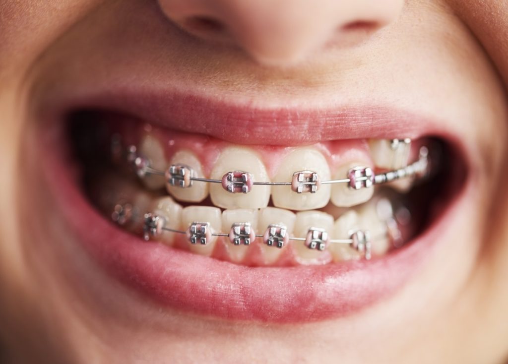 A Parents Guide To Braces For Kids 1024x734