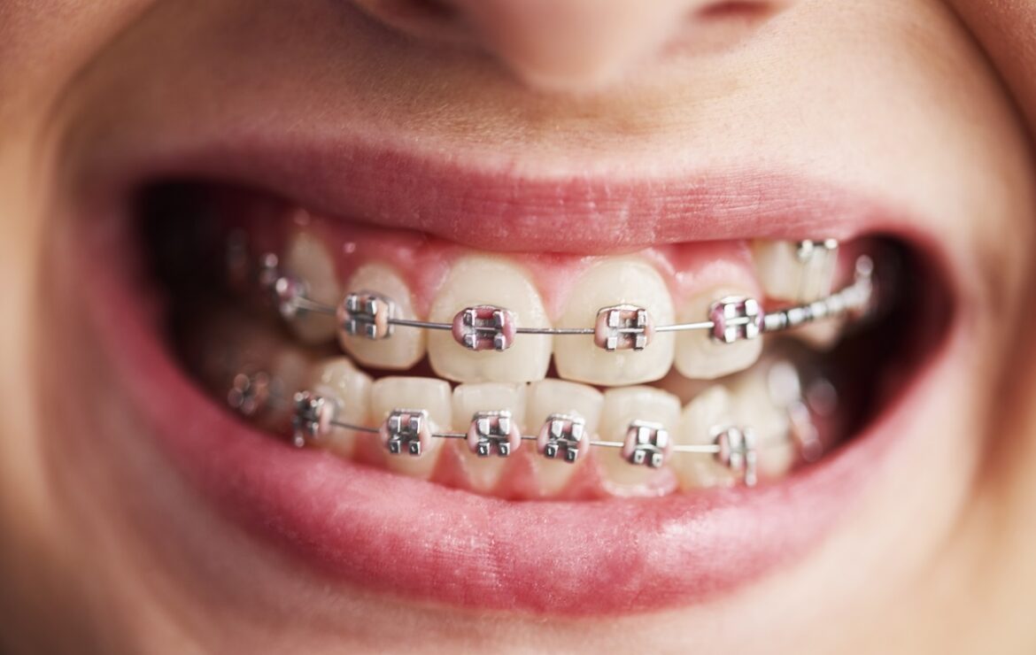 A Parent’s Guide to Braces for Kids