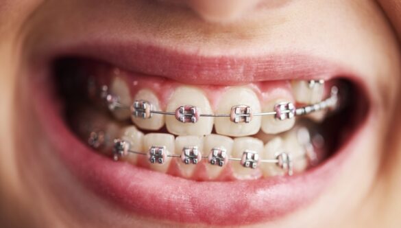 A Parent’s Guide to Braces for Kids