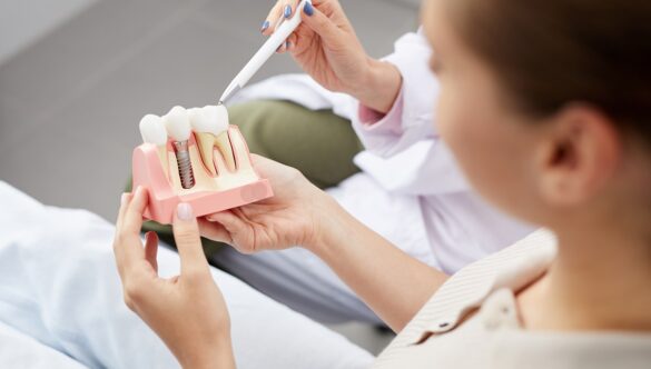 How to Care for Your Dental Implants