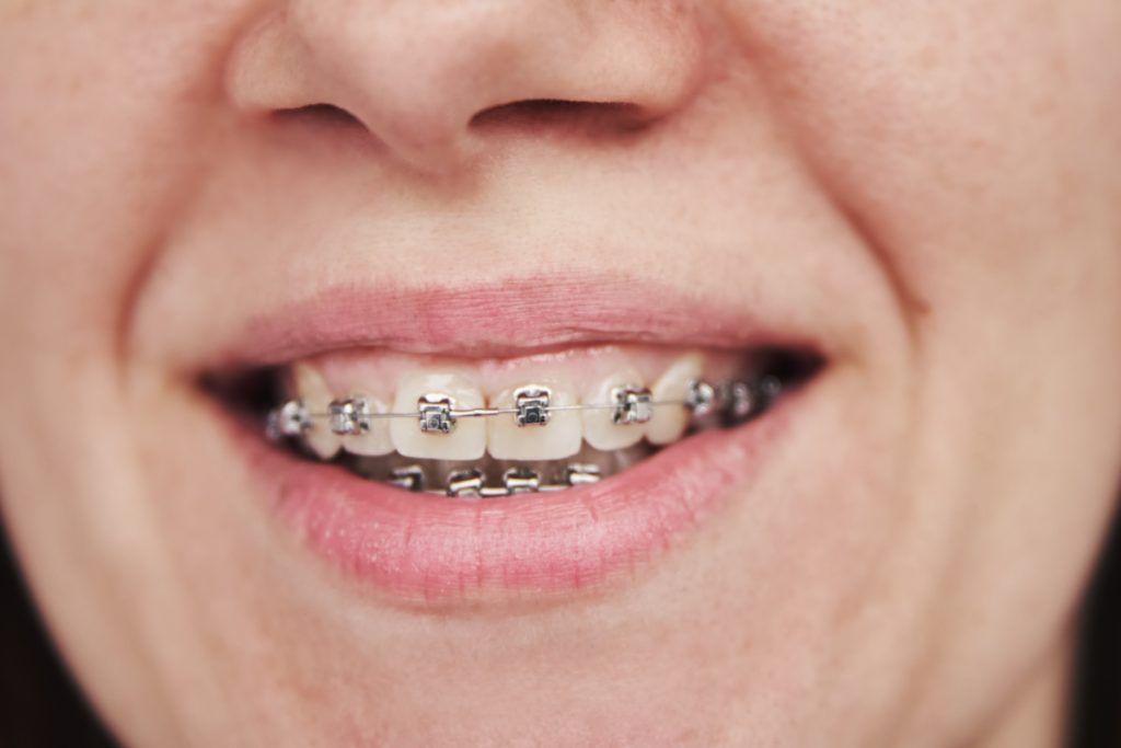 Woman With Braces On Teeth Closeup 2022 02 14 18 04 11 Utc 1 1024x683