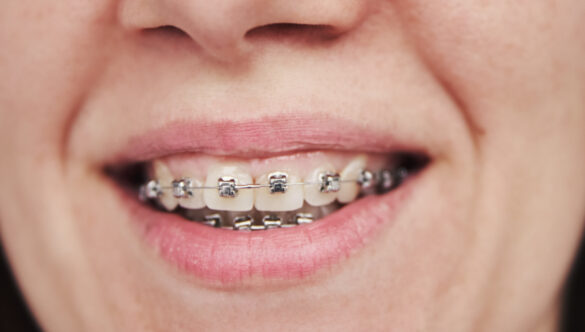 7 Reasons Why Your Dental Braces Are Still On