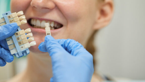 How To Prepare For Dental Implant Surgery