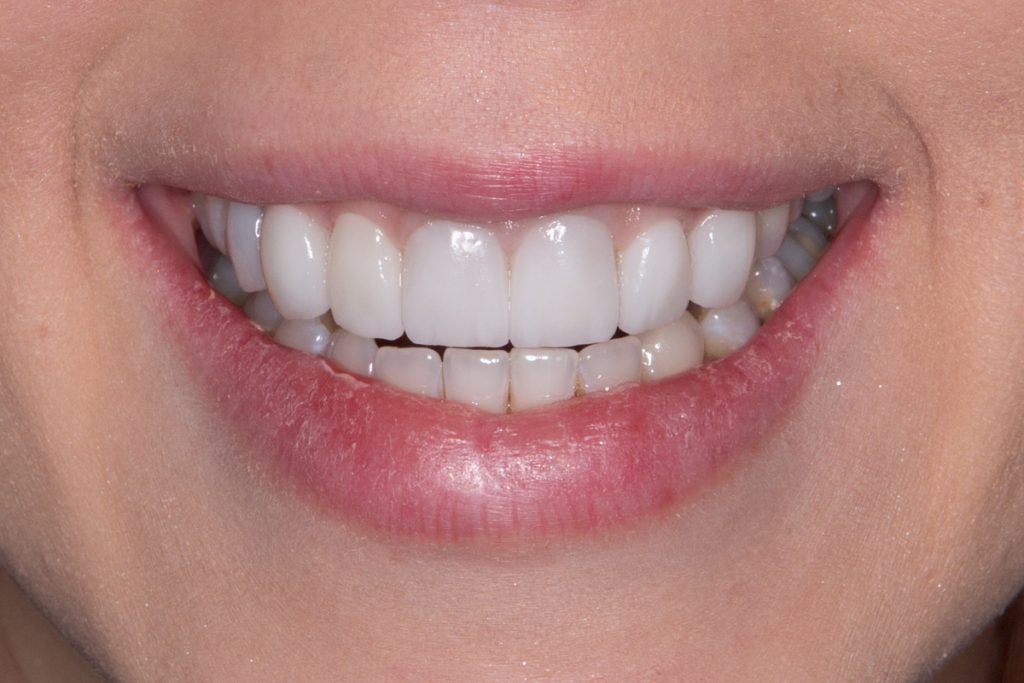 Smile Dental Veneers T20 PRYdgd 1 1024x683