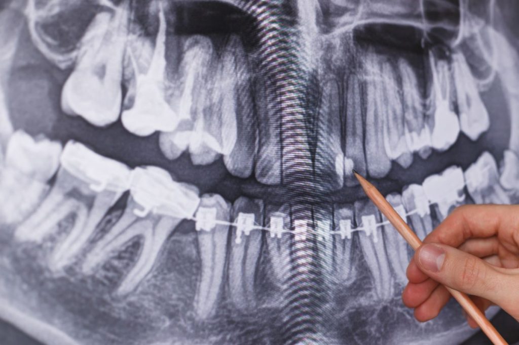 3 Types Of Dental X-ray