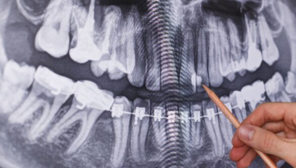 3 Types Of Dental X-ray