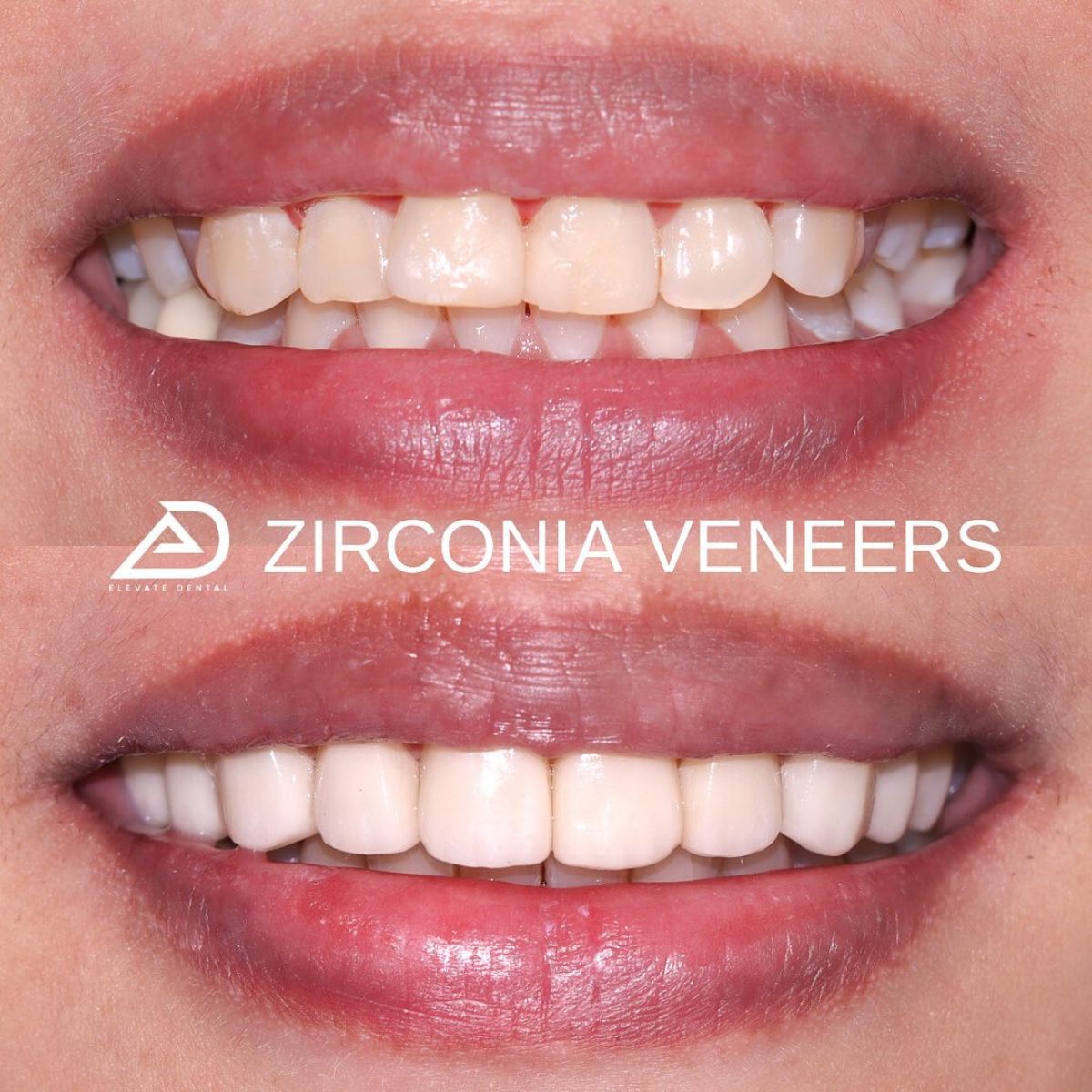 Veneers Price In The Philippines: Elevate Dental