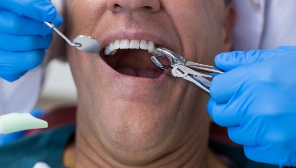 A Guide To Tooth Extraction Aftercare