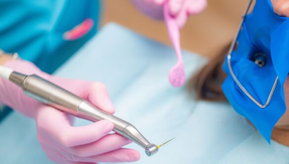 Root Canal Post-Treatment Tips