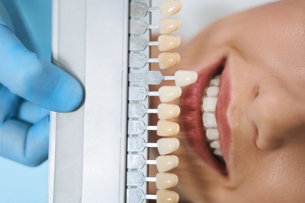 Top View Of Dentist With Veneers Palette Stock Pho 2021 09 03 15 37 44 Utc 1024x683