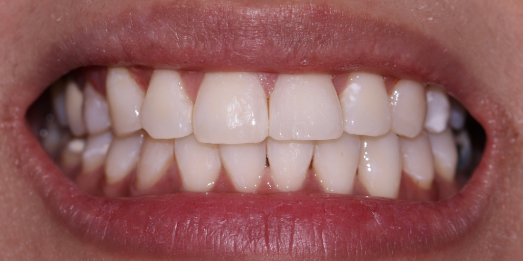 Opalescence Whitening Elevate Dental Before 1024x512