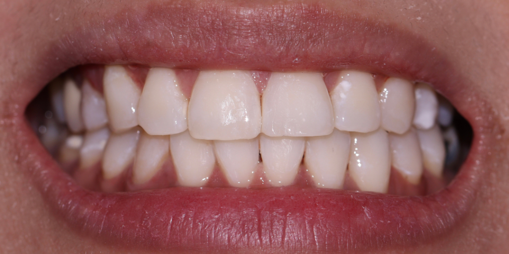 Opalescence Whitening Elevate Dental Before